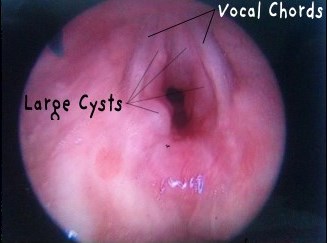 Elias's Cysts (2).jpg